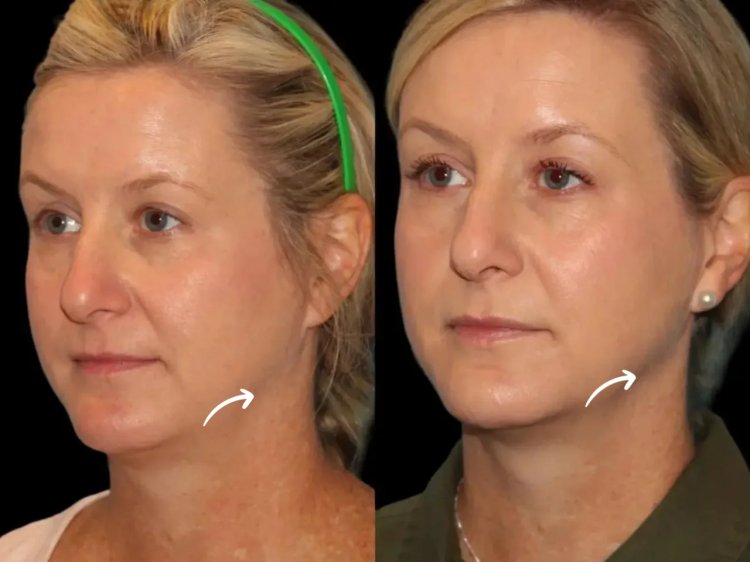 Sculptra for Chin Augmentation: Advice from the Best Plastic Surgeon in dubai