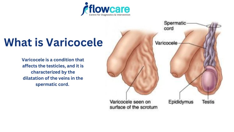 Understanding Varicocelectomy: Choosing Between Micro Varicocelectomy and Varicocele Embolization