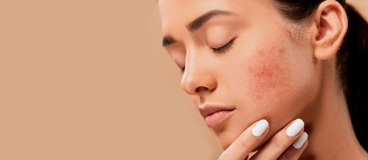 Who Provides the Best Acne Treatment Vienna?