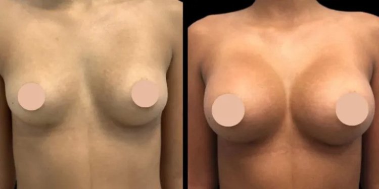 Best Breast Augmentation Surgeons in Dubai: What to Expect at Your Consultation